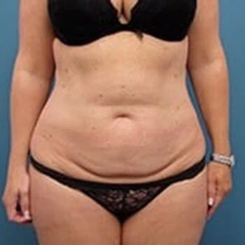 Front-view before photo of tummy tuck surgery performed by Dr. David Rankin in Jupiter, FL, case 4249.