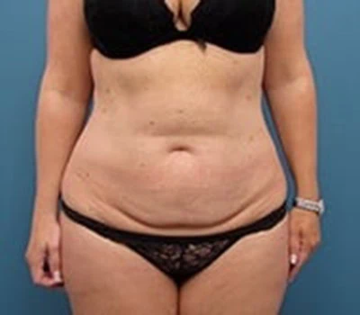 Before - Case 4249: Tummy Tuck and Liposuction (Hips)