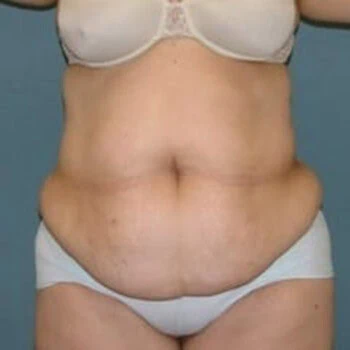 Front-view before photo of tummy tuck surgery performed by Dr. David Rankin in Jupiter, FL, case 4252.