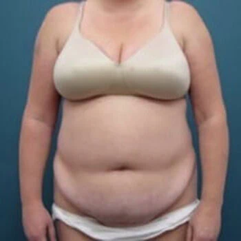 Front-view before photo of tummy tuck and liposuction surgery performed by Dr. David Rankin in Jupiter, FL, case 4255.