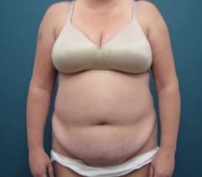 Before - Case #4255: Tummy Tuck and Liposuction (Hips)