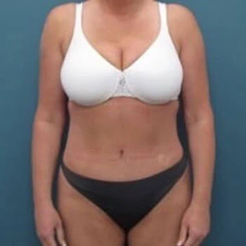 Front-view after photo of tummy tuck and liposuction surgery performed by Dr. David Rankin in Jupiter, FL, case 4255.