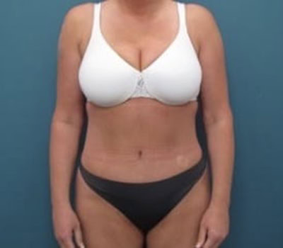 After - Case #4255: Tummy Tuck and Liposuction (Hips)