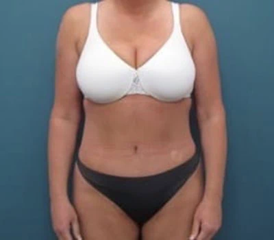After - Case #4255: Tummy Tuck and Liposuction (Hips)