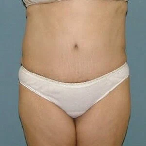 Front-view after photo of tummy tuck surgery performed by Dr. David Rankin in Jupiter, FL, case 4258.