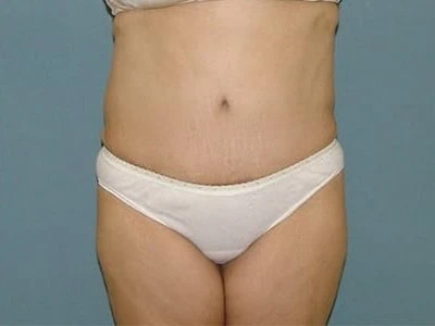 After - Case #4258: Tummy Tuck