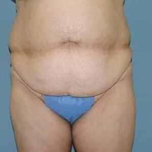 Front-view before photo of tummy tuck surgery performed by Dr. David Rankin in Jupiter, FL, case 4258.