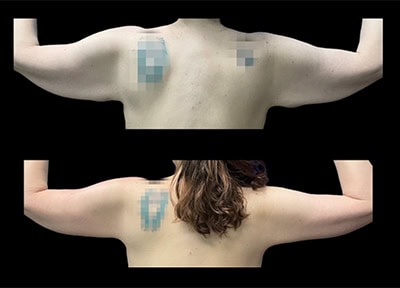 After - Case #3526: Arm Lift Surgery (Brachioplasty)