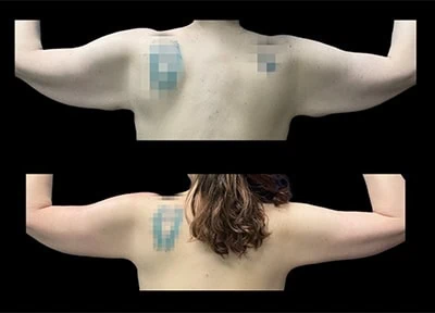 After - Case #3526: Arm Lift Surgery (Brachioplasty)