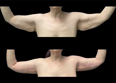 Before - Case #3526: Arm Lift Surgery (Brachioplasty)