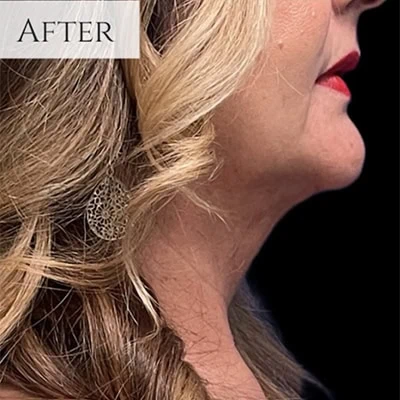 After - Case #3527: Submental Liposuction (Chin)