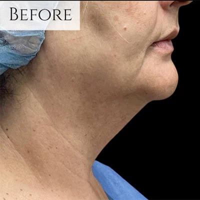 Before - Case #3527: Submental Liposuction (Chin)