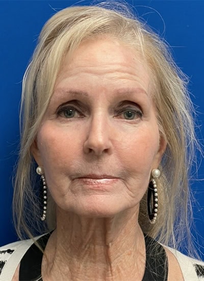 After - Case #3528: CO2 Laser Resurfacing