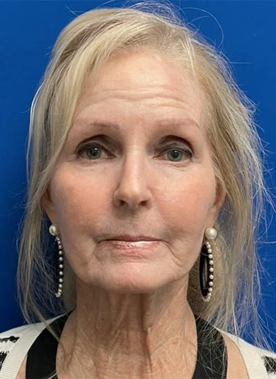 After - Case #3528: CO2 Laser Resurfacing