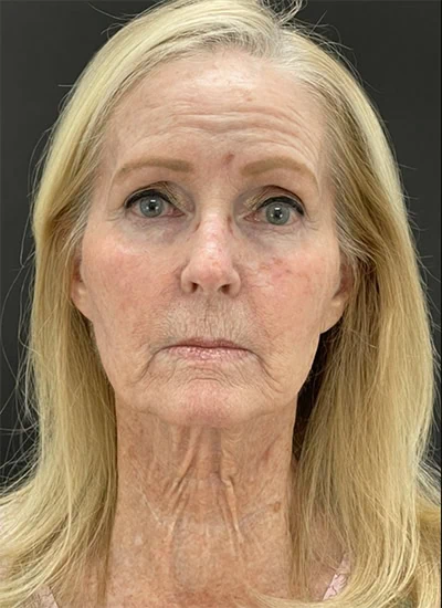 Before - Case #3528: CO2 Laser Resurfacing