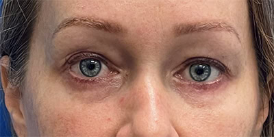 After - Case #3529: Lower Blepharoplasty
