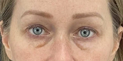 Before - Case #3529: Lower Blepharoplasty