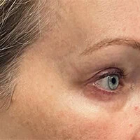 Right-view after photo of lower blepharoplasty surgery performed by Dr. Allyson Deziel in Jupiter, FL, case 3529.