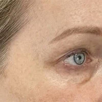 Right-view after photo of lower blepharoplasty surgery performed by Dr. Allyson Deziel in Jupiter, FL, case 3529.