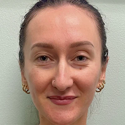 After - Case #3530: Otoplasty (Ear Reshaping)