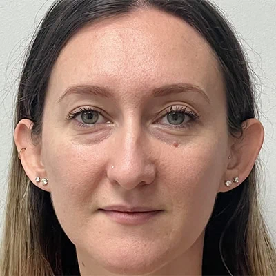 Before - Case #3530: Otoplasty (Ear Reshaping)