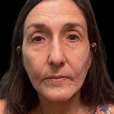 Front-view after photo of facelift / neck lift surgery performed by Dr. Allyson Deziel in Jupiter, FL, case 3531.