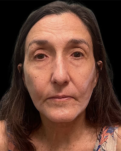 After - Case #3531: Facelift and Neck Lift with Facial Fat Grafting