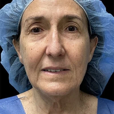 Front-view before photo of facelift / neck lift surgery performed by Dr. Allyson Deziel in Jupiter, FL, case 3531.