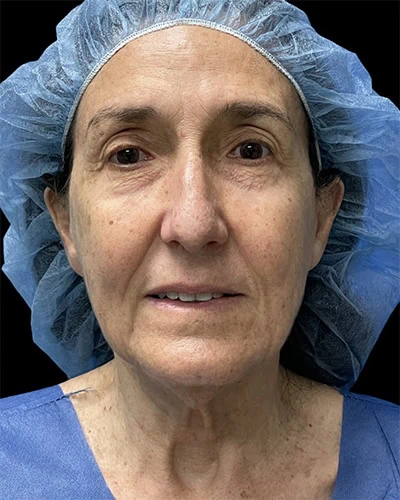Before - Case #3531: Facelift and Neck Lift with Facial Fat Grafting