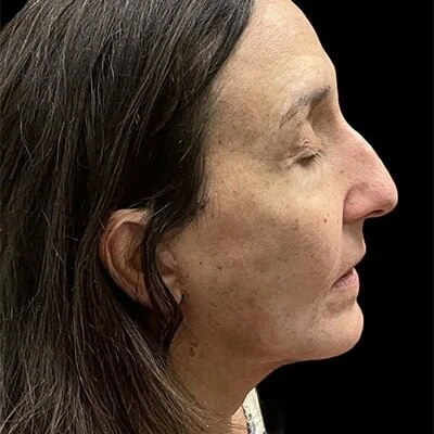 Right-view after photo of facelift / neck lift surgery performed by Dr. Allyson Deziel in Jupiter, FL, case 3531.