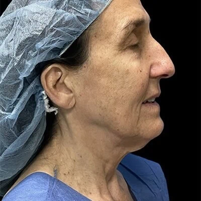 Right-view before photo of facelift / neck lift surgery performed by Dr. Allyson Deziel in Jupiter, FL, case 3531.