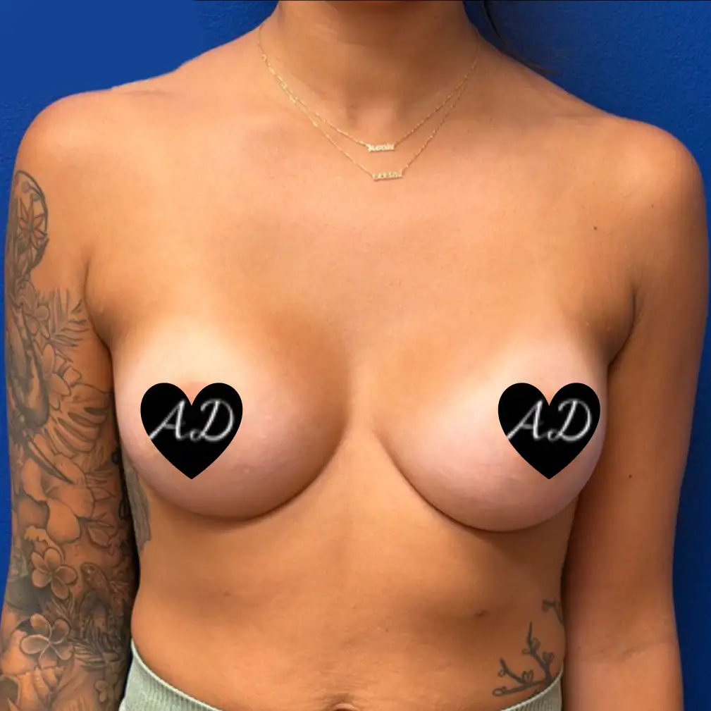 After - Case #3533: Breast Augmentation