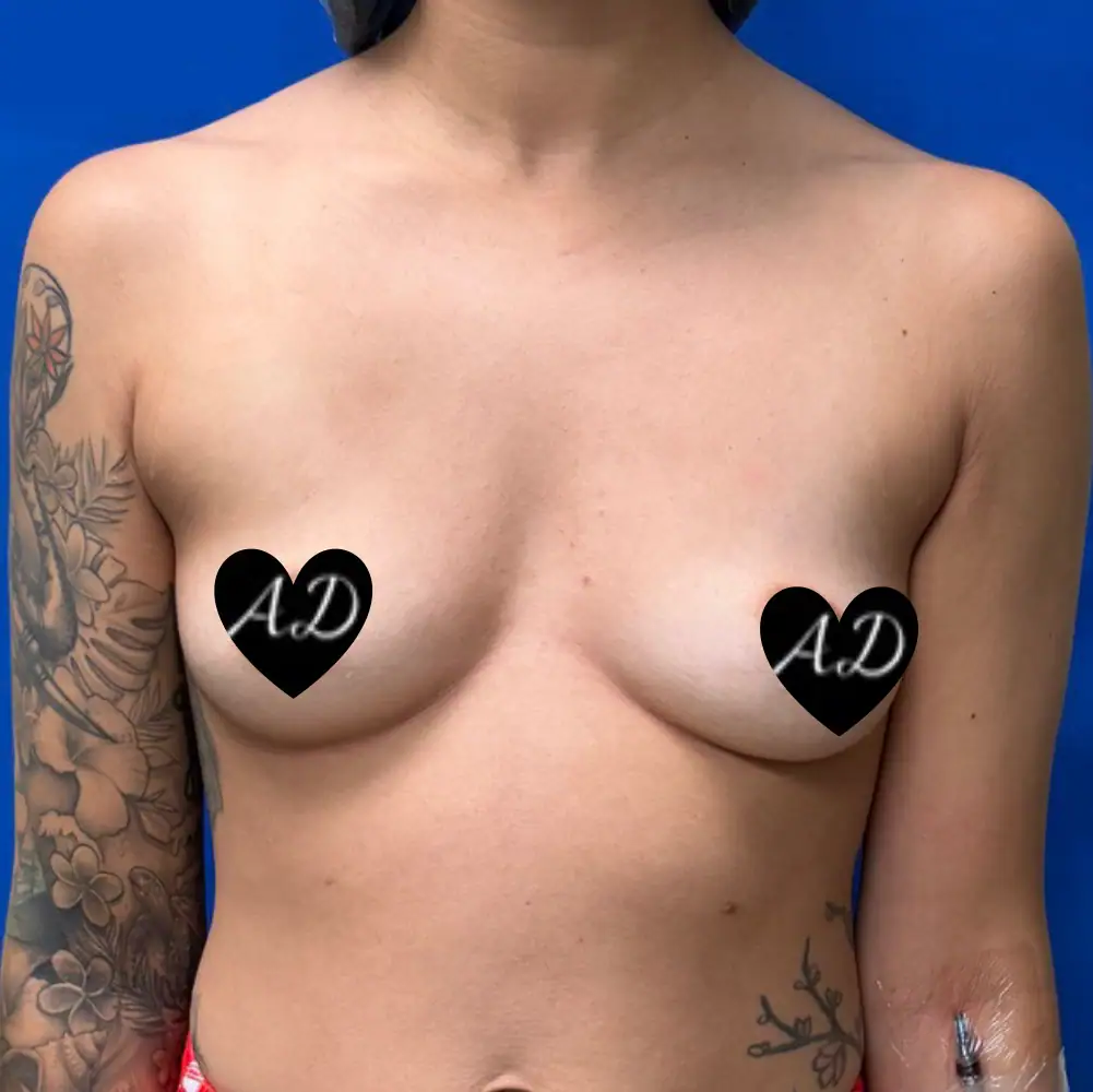 Before - Case #3533: Breast Augmentation