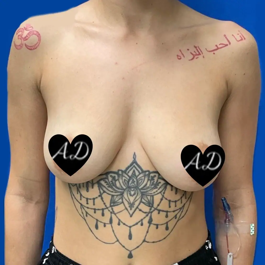 Before - Case #3534: Breast Augmentation & Mastopexy