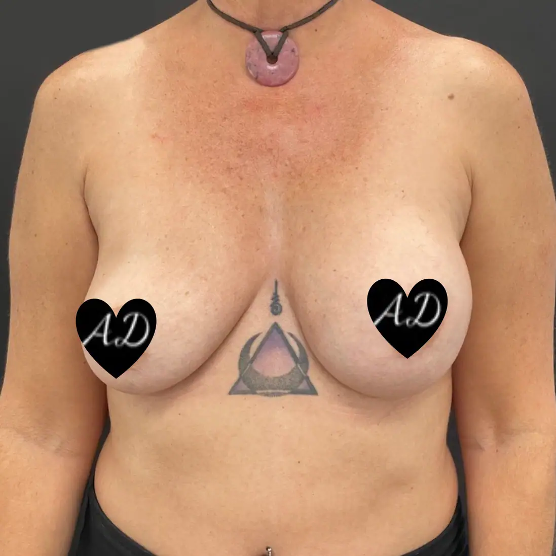 Before - Case #3535: Breast Implant Exchange