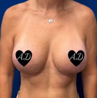 After - Case #3536: Breast Implant Exchange & Lift