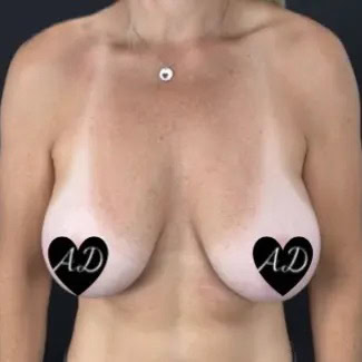 Before - Case #3536: Breast Implant Exchange & Lift