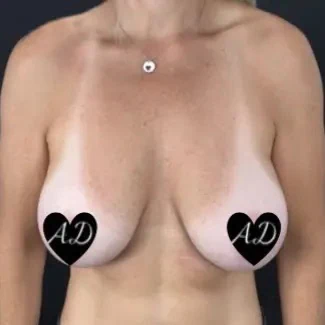 Before - Case #3536: Breast Implant Exchange & Lift