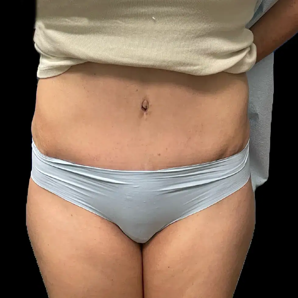 After - Case #3537: Tummy Tuck