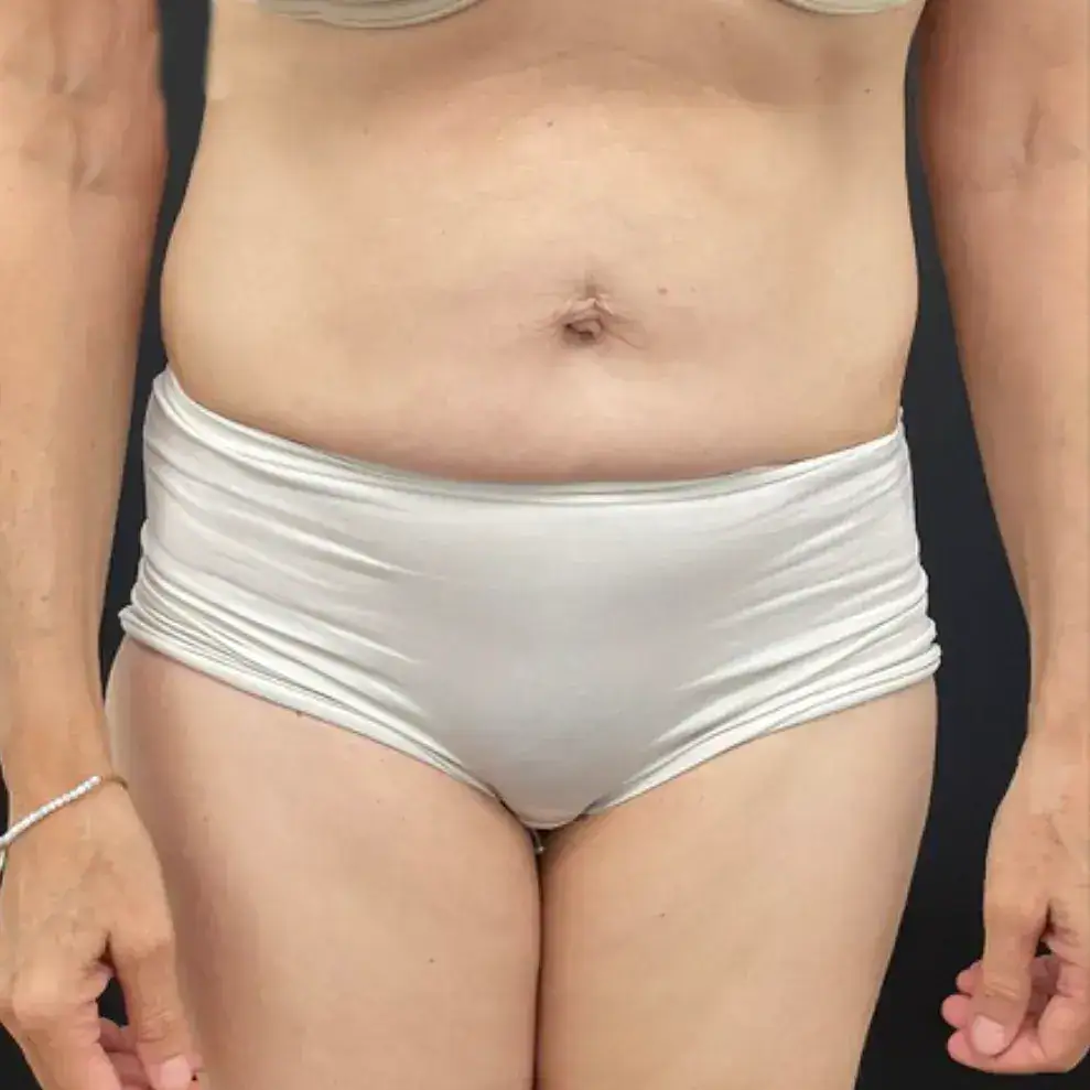 Before - Case #3537: Tummy Tuck