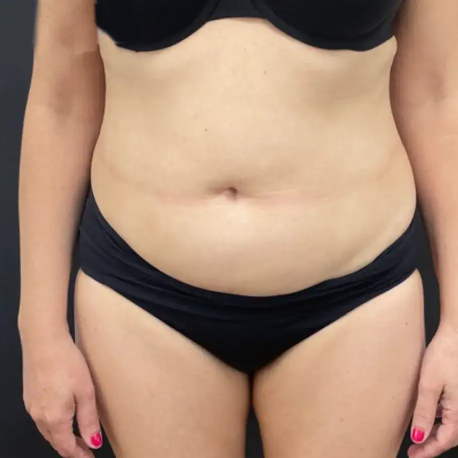 Before - Case #3538: Tummy Tuck