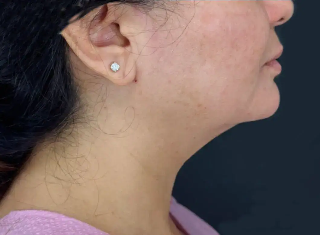 After - Case #3539: Submental Liposuction