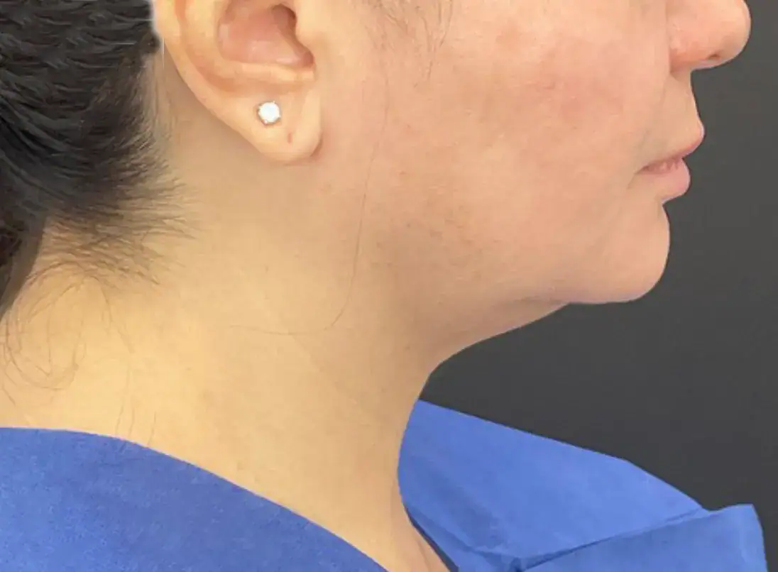 Before - Case #3539: Submental Liposuction