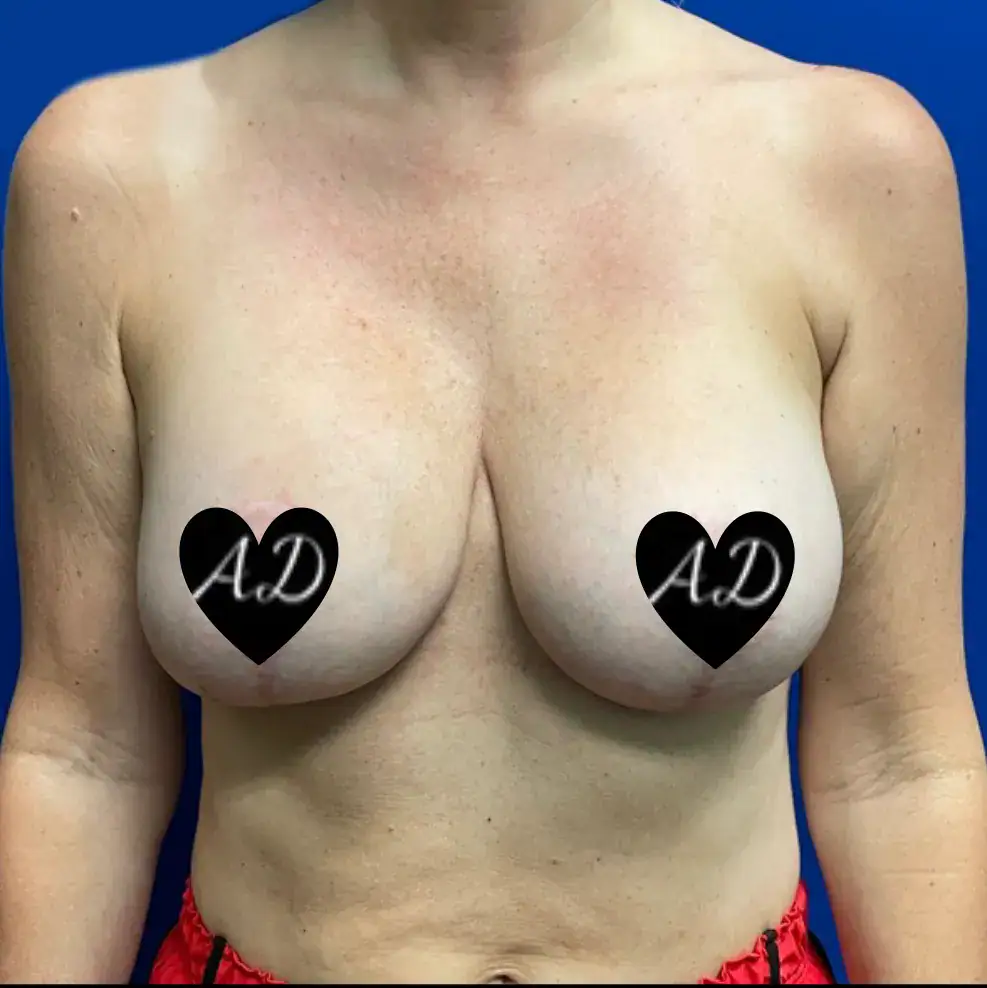 After - Case #3540: Breast Implant Exchange