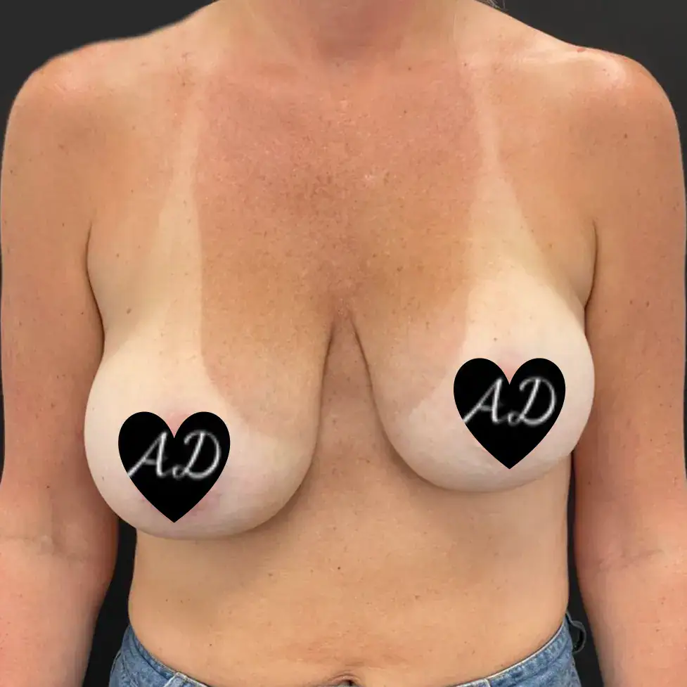 Before - Case #3540: Breast Implant Exchange