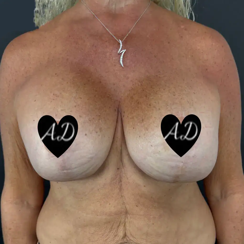 After - Case #3542: Breast Augmentation & Mastopexy