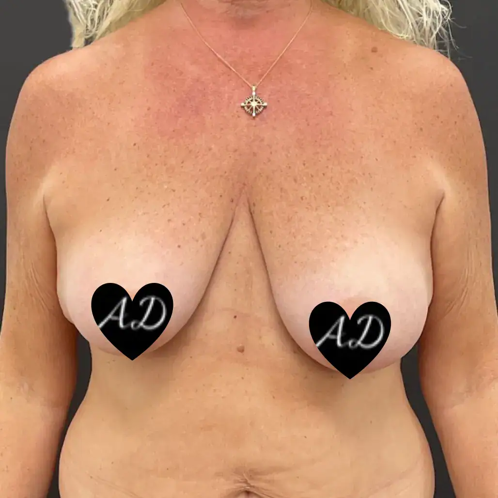 Before - Case #3542: Breast Augmentation & Mastopexy