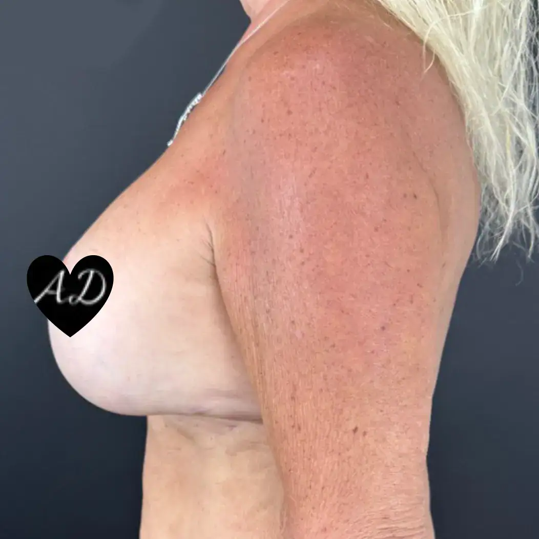 After thumbnail