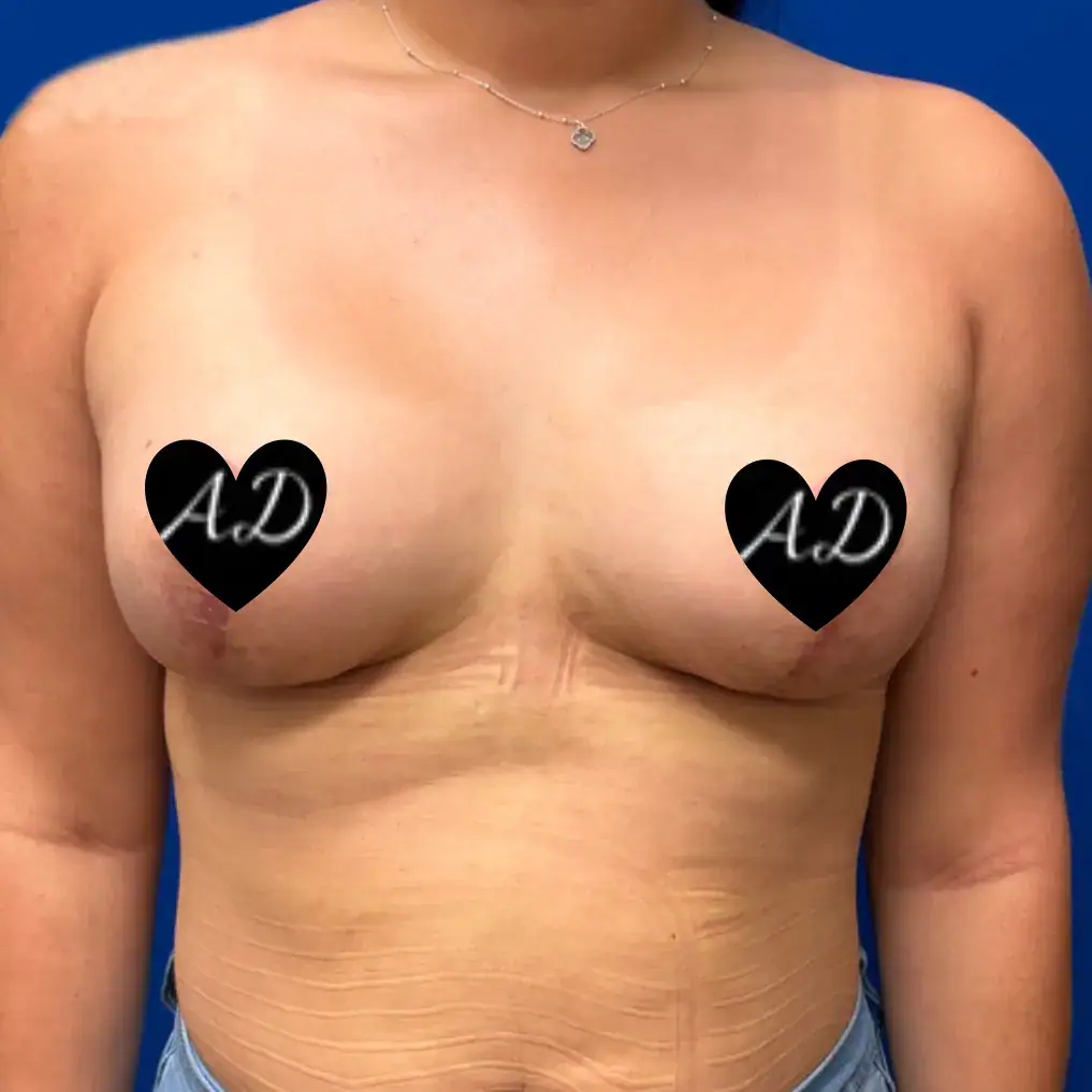 After - Case #3543: Breast Augmentation & Mastopexy