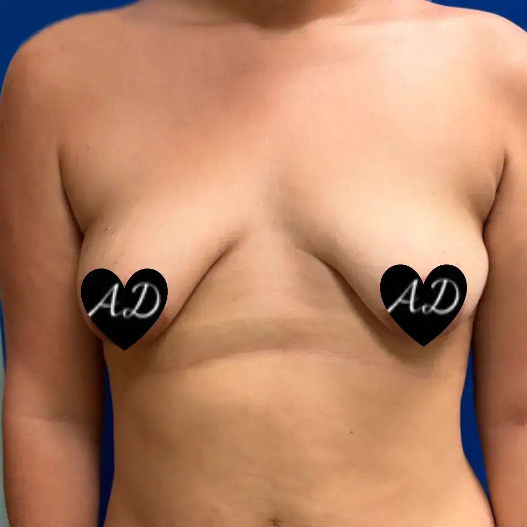 Before - Case #3543: Breast Augmentation & Mastopexy